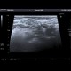 Sicca syndrom, salivary glands: US - Ultrasound
